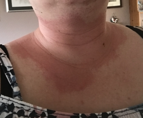 What does this rash look like?