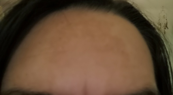 Lightening dark stripe on forehead