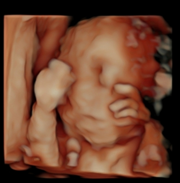 25 weeks 4 days - baby 2lbs