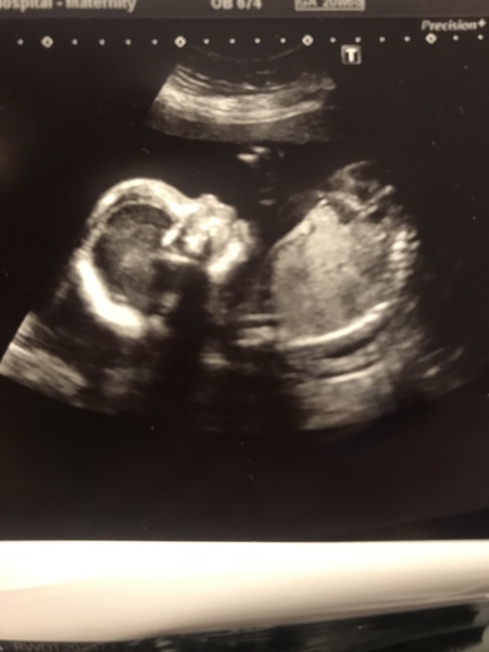 Pregnant after miscarriage part 4, TTC graduates