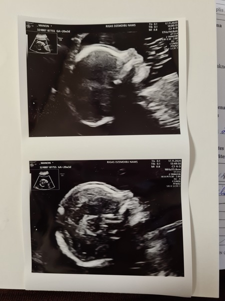 Pregnant after miscarriage part 4, TTC graduates