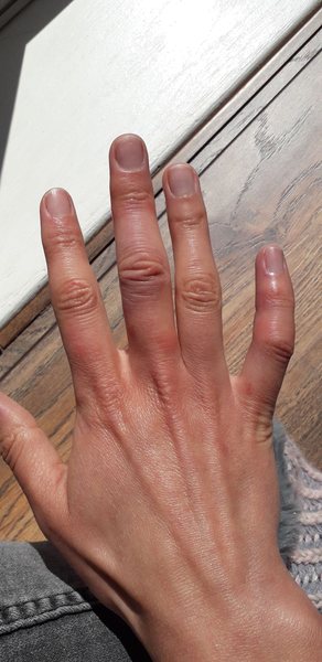Are these chilblains?