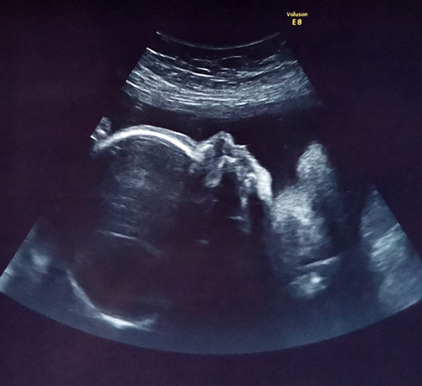 Is my baby's scan photo normal?