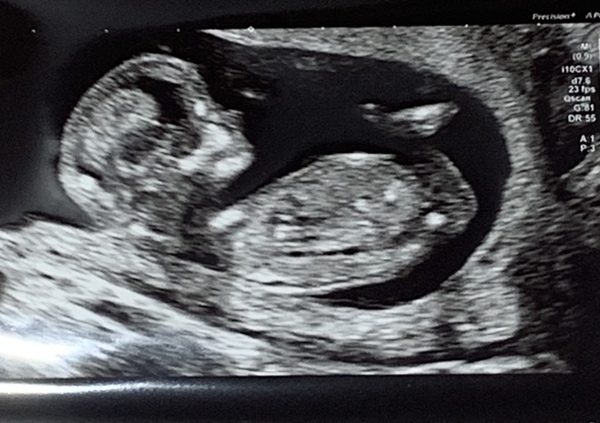 Is anyone else due on the 22nd may 2021?