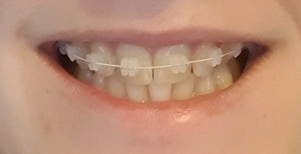 Should I get braces...