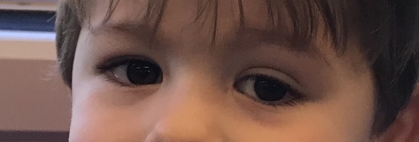 Baby with uneven size eyes