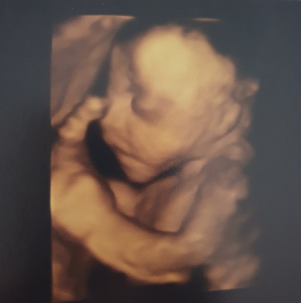 Pregnant After MMC - Thread 4
