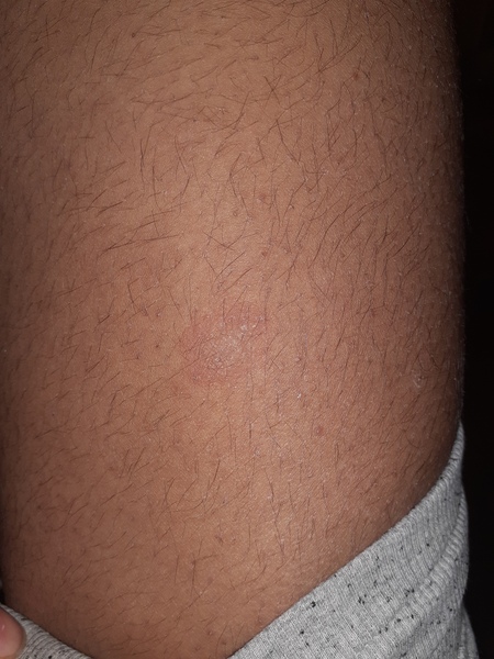 Rash and body hair