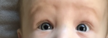 Baby with uneven size eyes