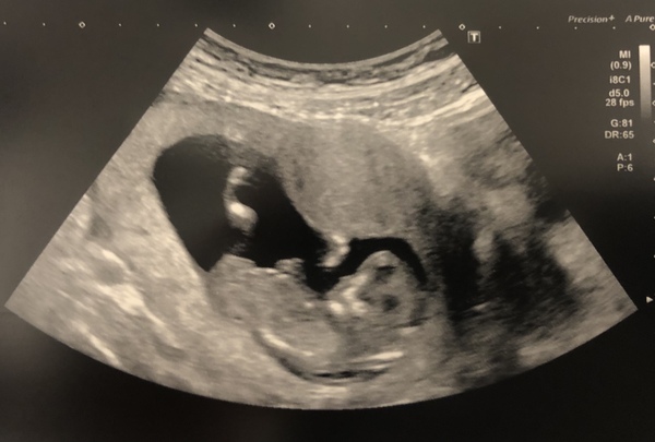 12 week scan tomorrow - panicking!