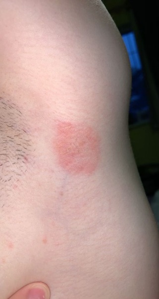 What sort of a rash have you seen in connection with covid?