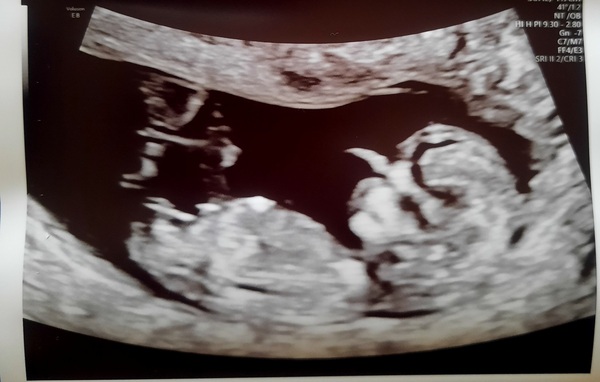 Pregnant After MMC - Thread 4