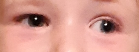 Baby with uneven size eyes