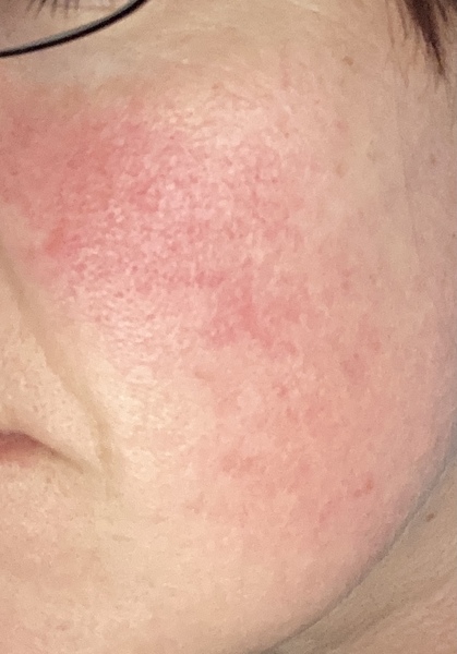 Skin care routine for rosacea
