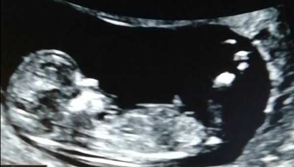12 weeks scan, girl or boy?