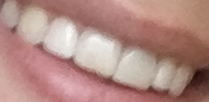 Should I get braces...