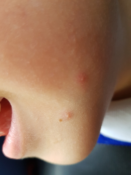 Spots on 6-year old's face
