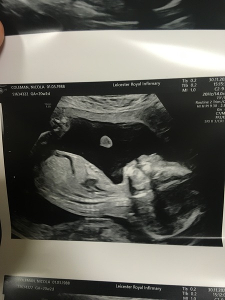 Pregnant After MMC - Thread 4
