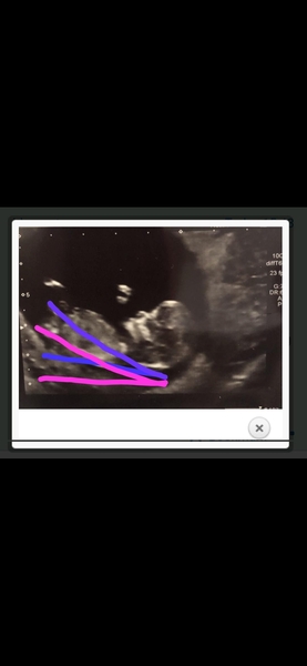 I'm thinking it's a girl. What do you think?
