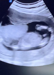 Boy on 14 week ultrasound?