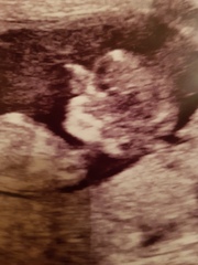 Nuchal scan