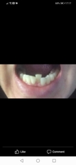 Invisalign