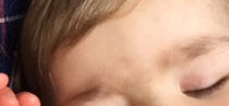 Toddler eyebrow/forehead abnormality?