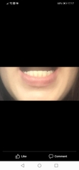 Invisalign