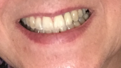 Braces as an adult