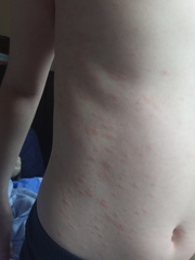 My son has tested positive. Unusual presentation. Hand hold please.
