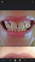 Braces as an adult