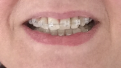 Braces as an adult