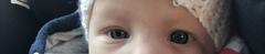 Baby with uneven size eyes
