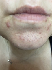 LARGE pores and crap skin