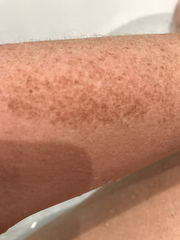 What might these skin patches be?