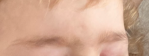 Toddler eyebrow/forehead abnormality?