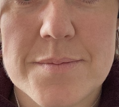 Skin care routine for rosacea
