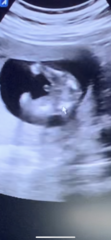 Boy on 14 week ultrasound?