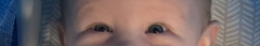 Baby with uneven size eyes