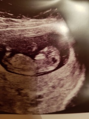 Nuchal scan