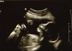 12 + 20 week scan gender guesses
