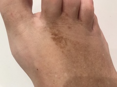 What might these skin patches be?