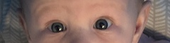 Baby with uneven size eyes