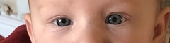 Baby with uneven size eyes