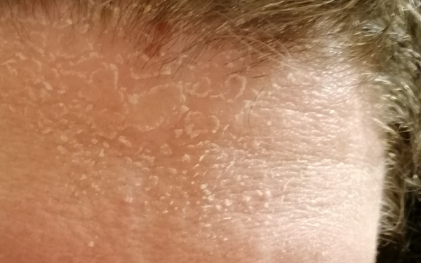 Dandruff and dry scalp