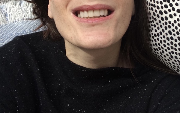 Have you had porcelain veneers done?