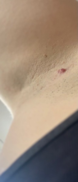 What is this under my armpit ??