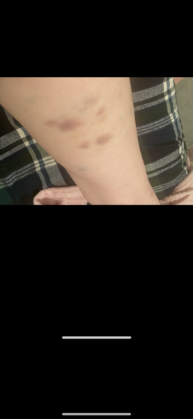 Unexplained bruising? Worried?