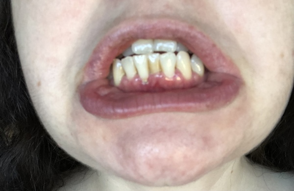 Gum disease (just been diagnosed)