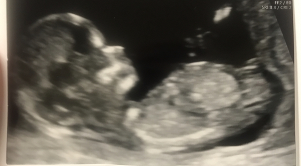 Do you want me to guess the sex? 12 week scans.